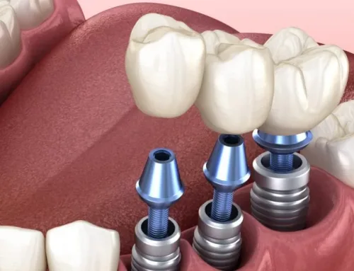 İmplant Tedavisi Nedir? Hangi Durumlarda Uygulanır?