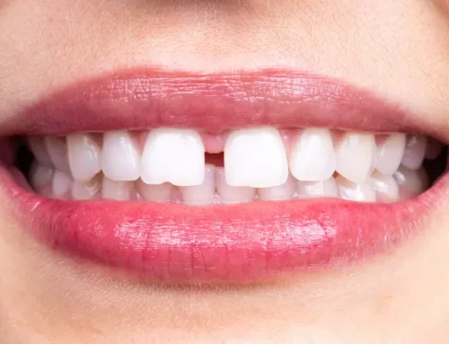 Diastema ( Ayrık Diş ) Tedavisi